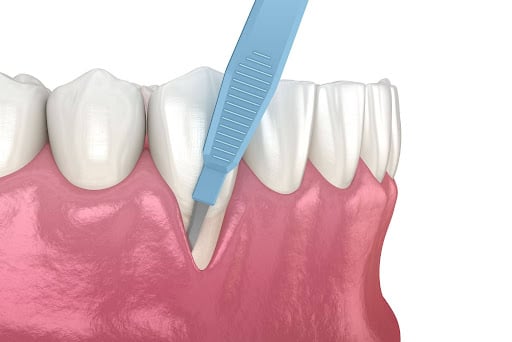Illustration of gum recession around a tooth during periodontal assessment.